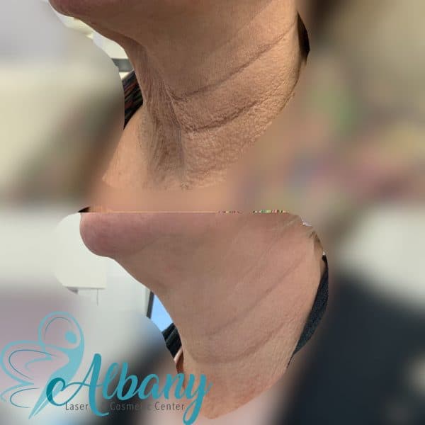 Neck lift Edmonton