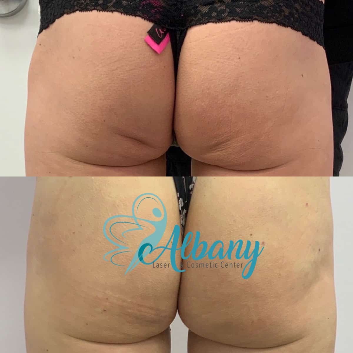 Brazilian Butt lift with Sculptra: Case No. 1085