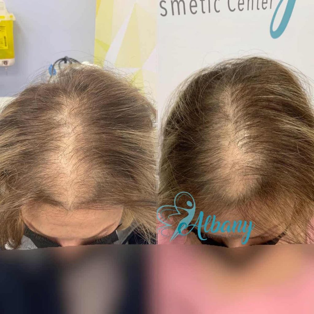 Hair restoration Edmonton