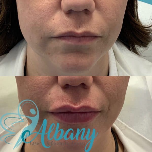 Russian lip fillers Edmonton