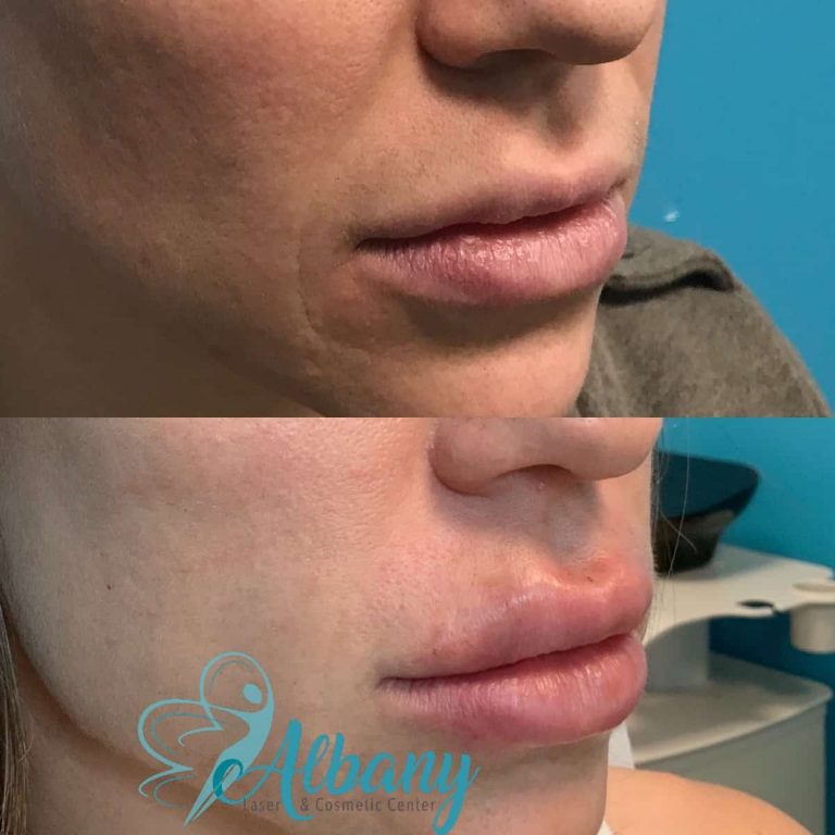 Russian Lip Fillers Edmonton - Albany Laser Edmonton