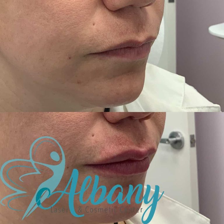 Russian lip fillers Edmonton