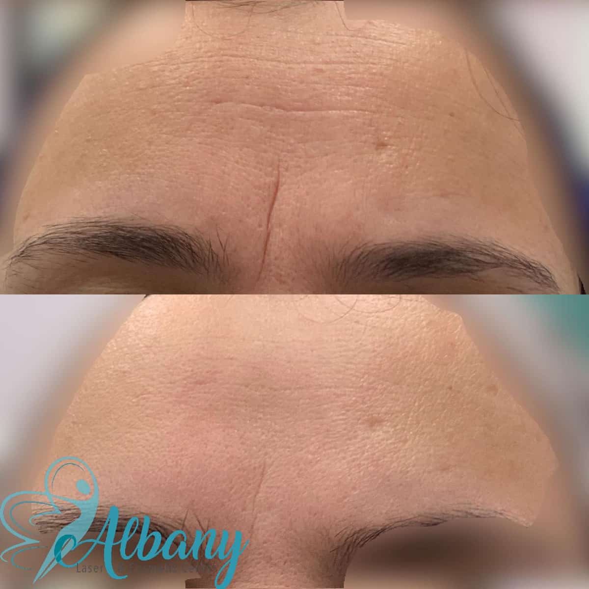 Botox for the frownline