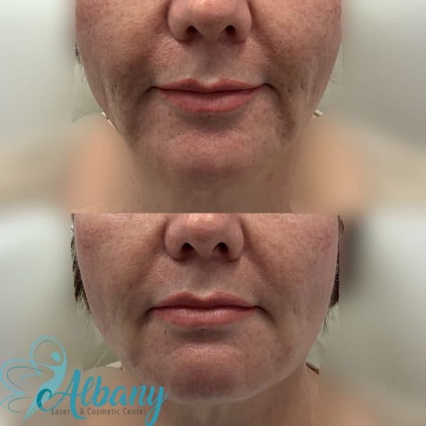 Thread facelift Edmonton