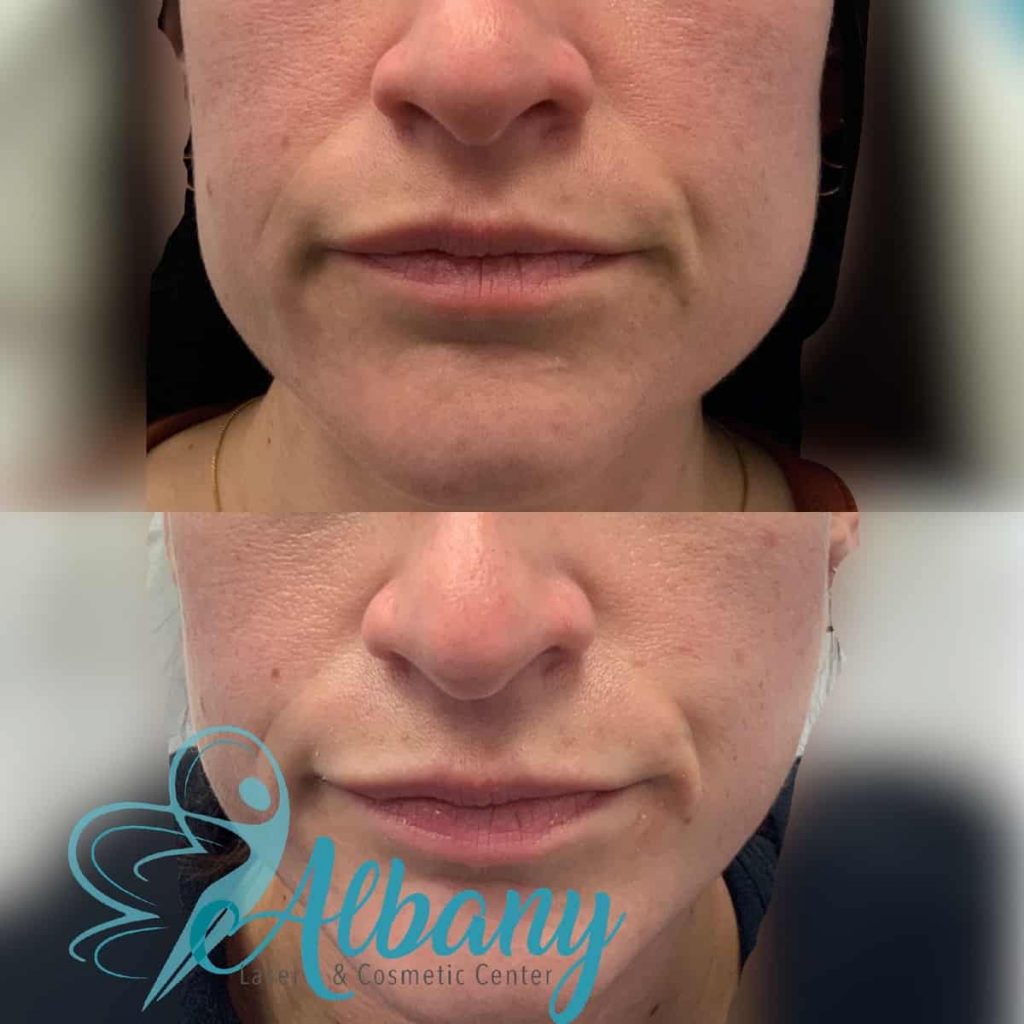 Botox Masseter