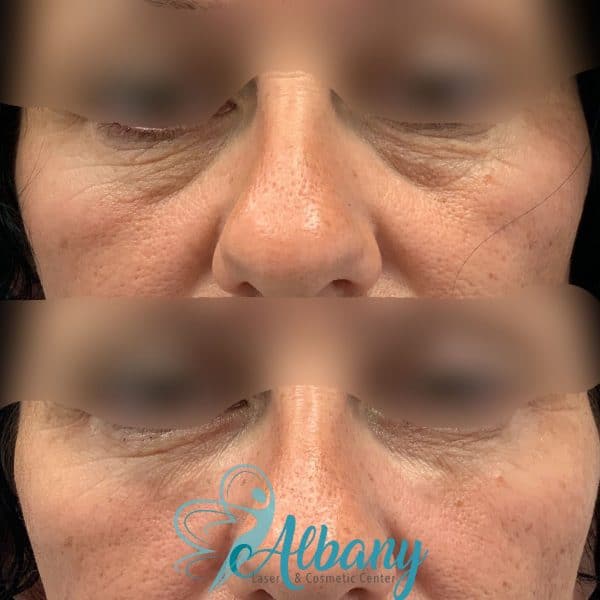 under eye fillers