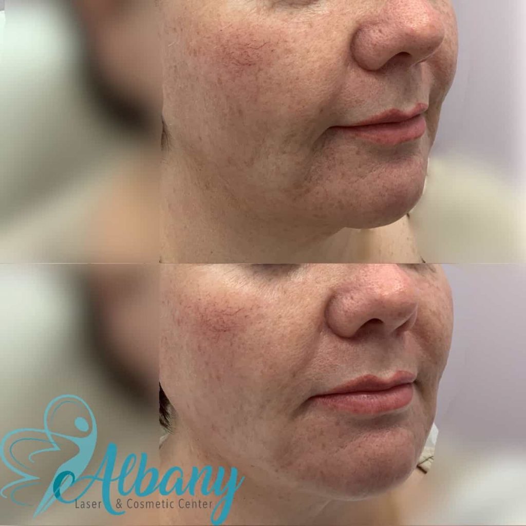 Thread facelift Edmonton