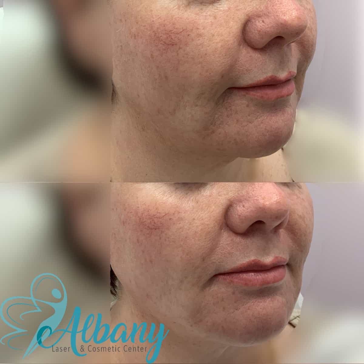 Thread facelift Edmonton