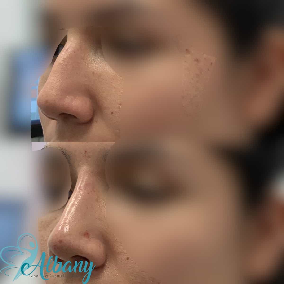 nose fillers Edmonton