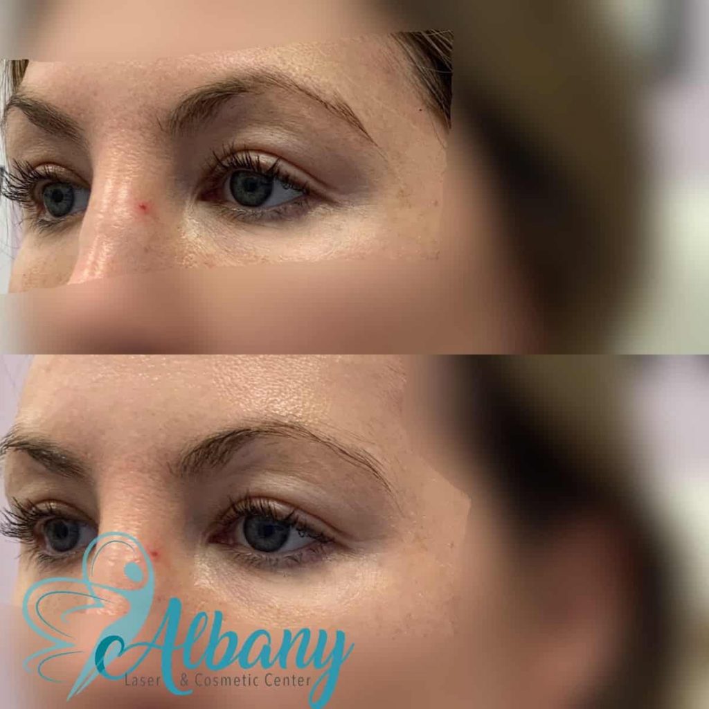 EyeBrow lift edmonton