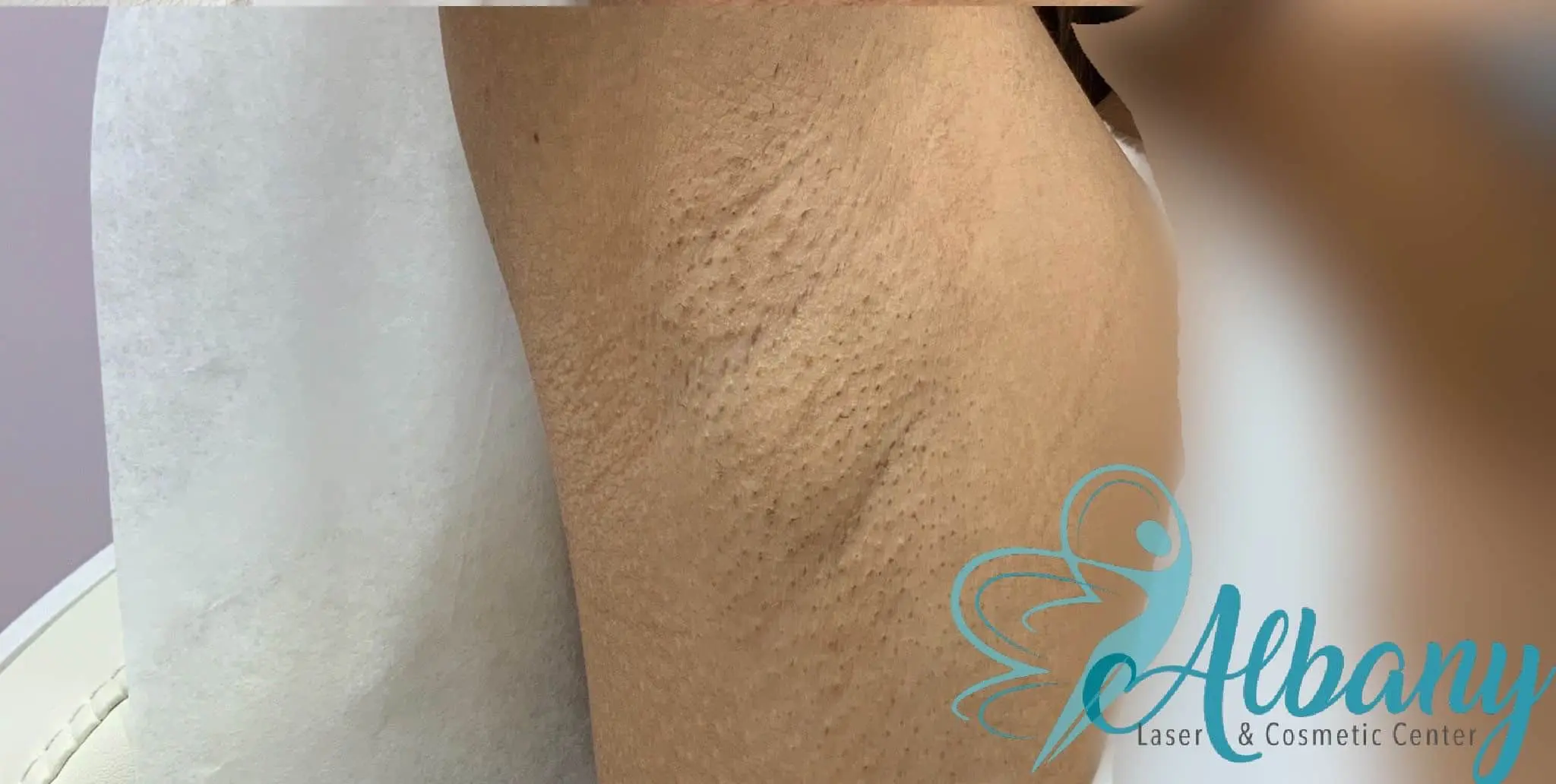 Underarm Whitening Results Procedure Results and Cost