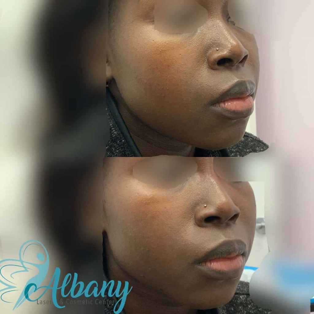 facial fillers