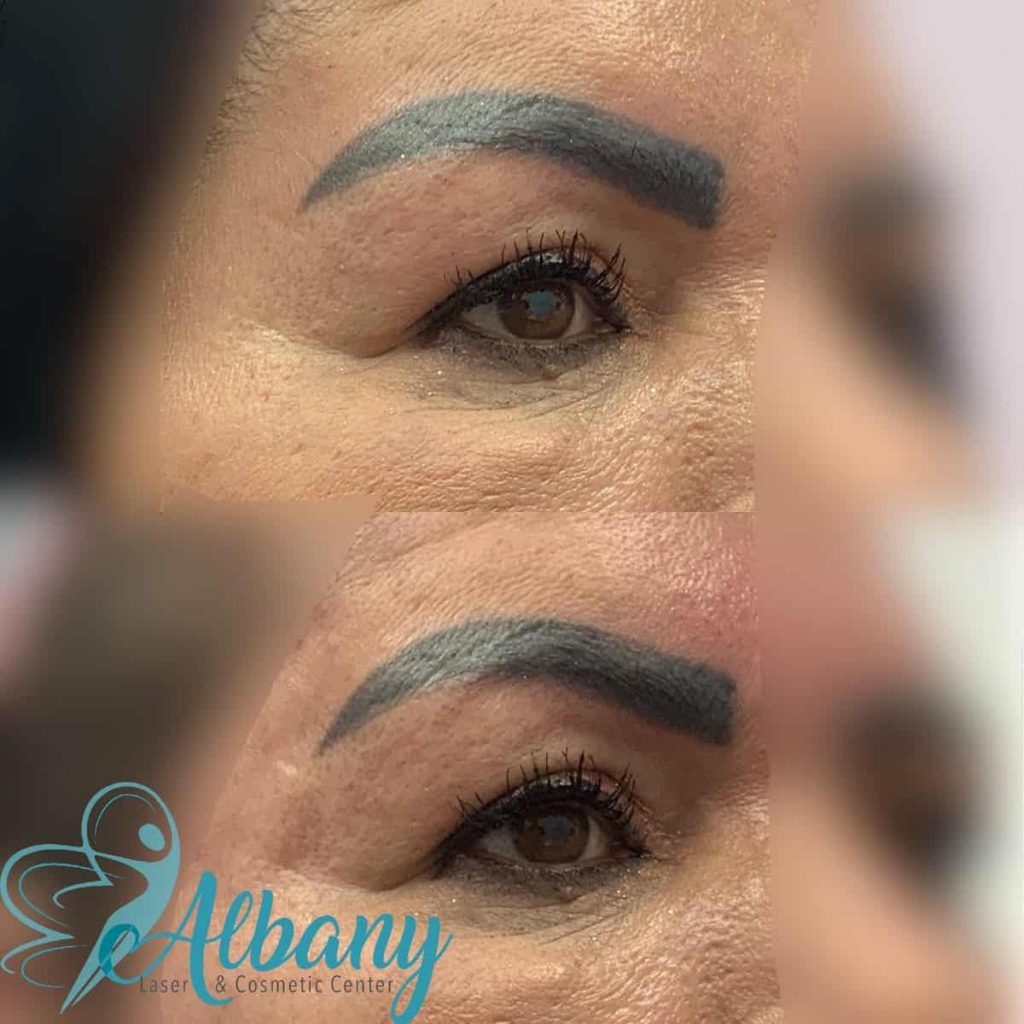 Eyebrow lift Edmonton