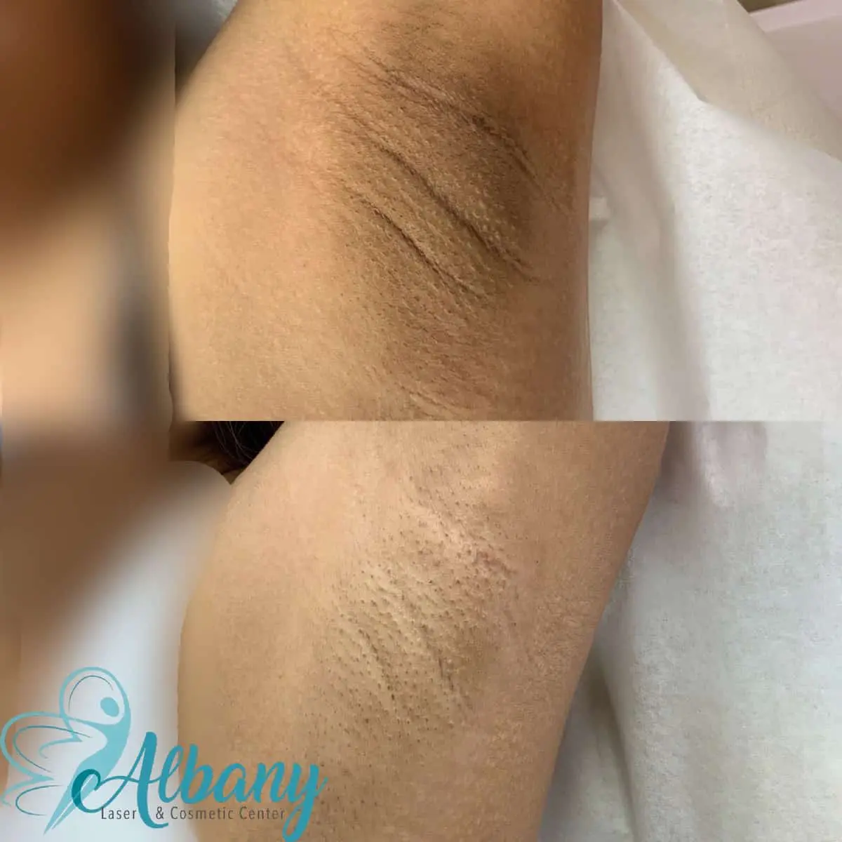 results of Underarm whitening