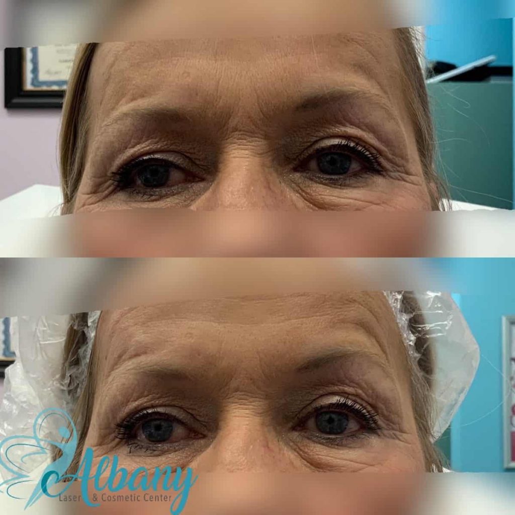 eyebrow lift edmonton