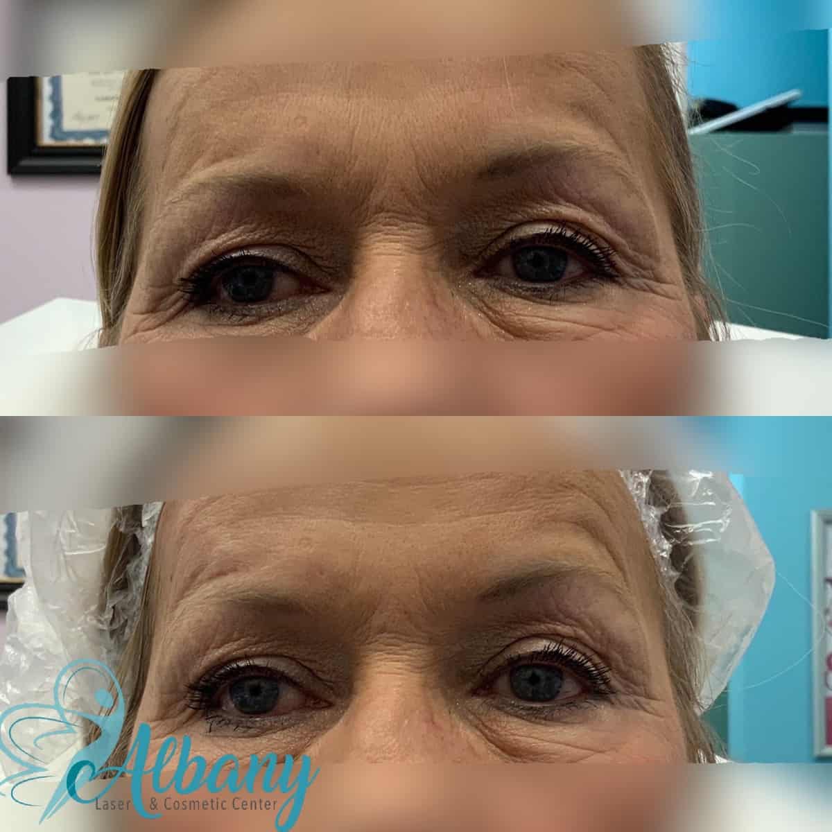 eyebrow lift edmonton