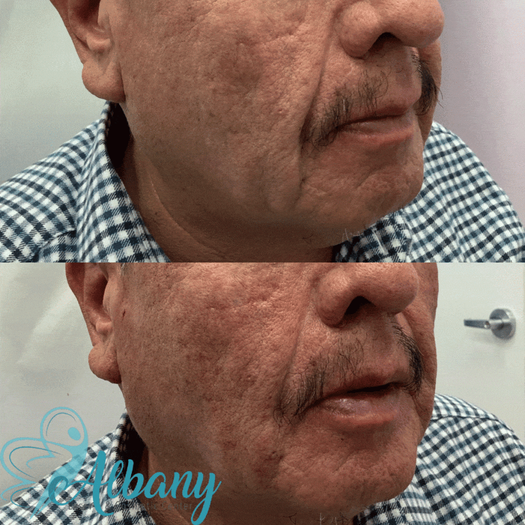 MINI FACE LIFT