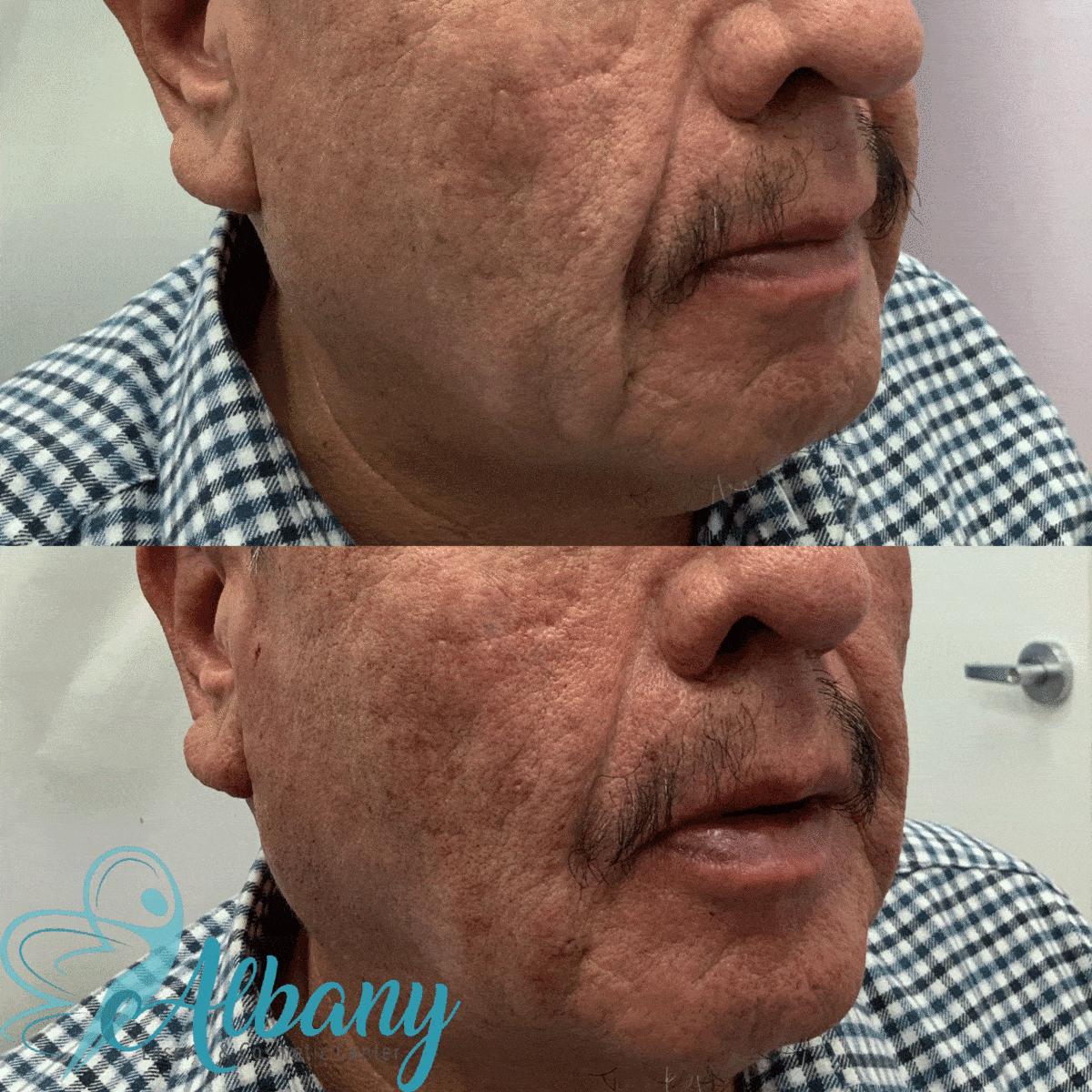 MINI FACE LIFT
