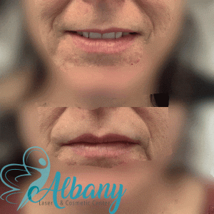 Lip fillers
