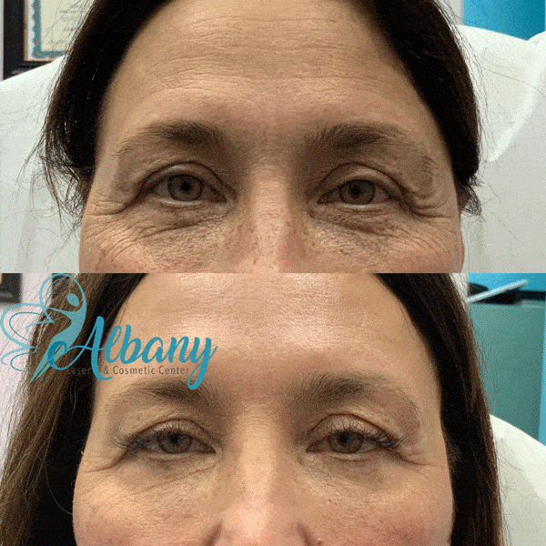 Before and after smile lines treatment
