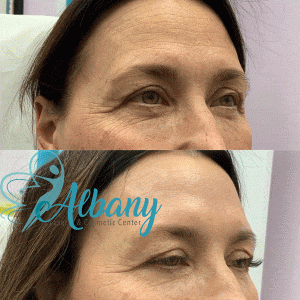 Botox results smile lines