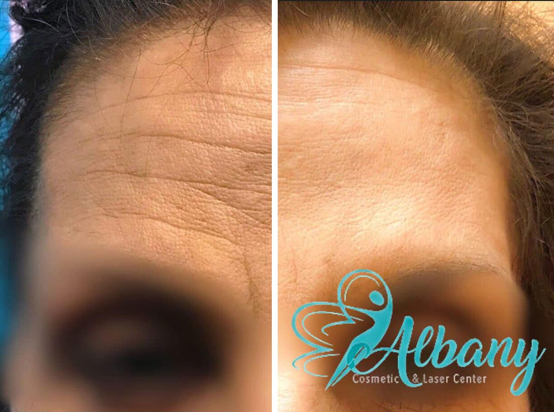 Forehead Lines Correction at Albany Cosmetic and Laser Centre