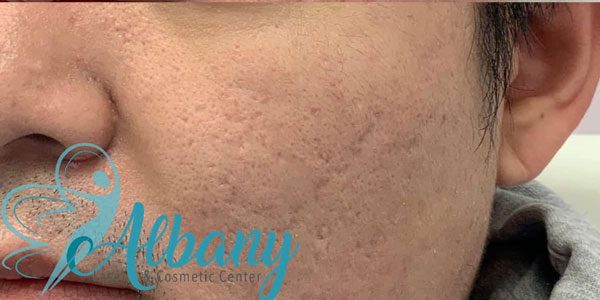 After-acne-scars-treatment-1019