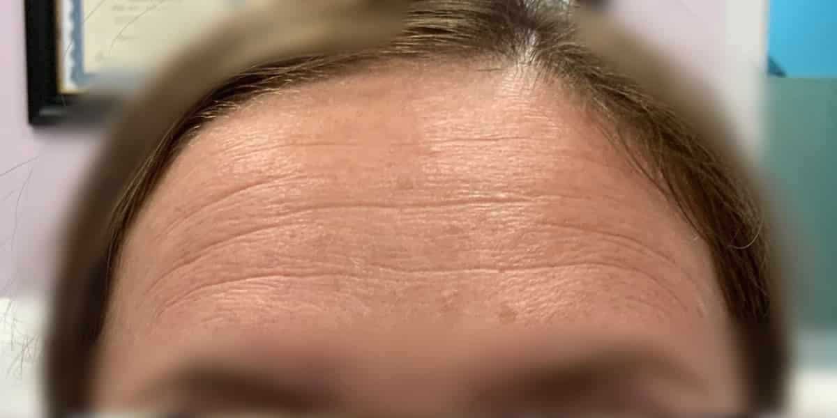 Before-Botox-forehead-case-1032