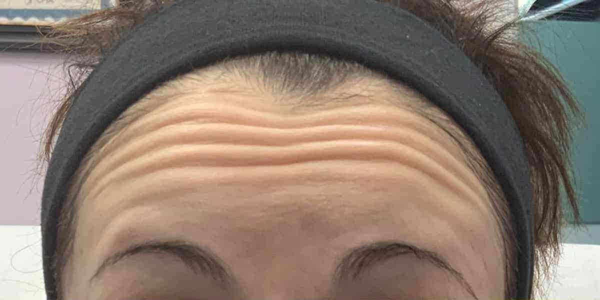 Forehead wrinkles