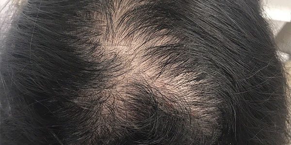 Before-hair-loss-treatment