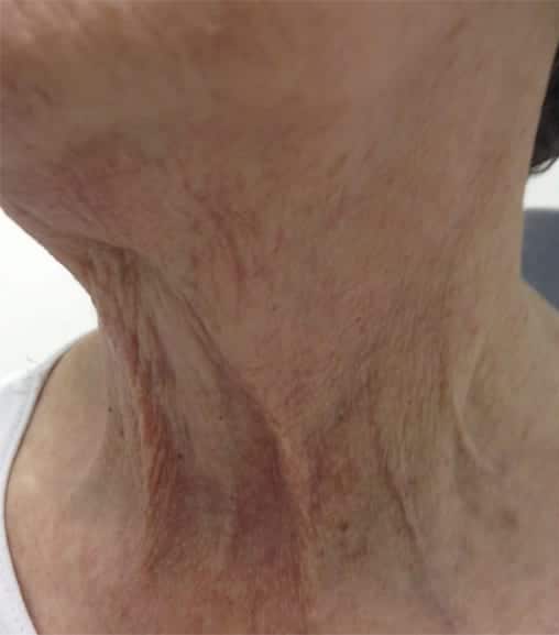 Before neck tightening