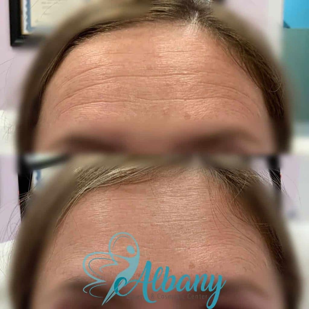 Botox results Edmonton