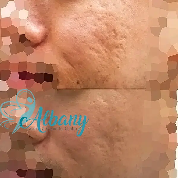 acne scars treatment results