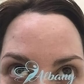 After Botox forehead lines