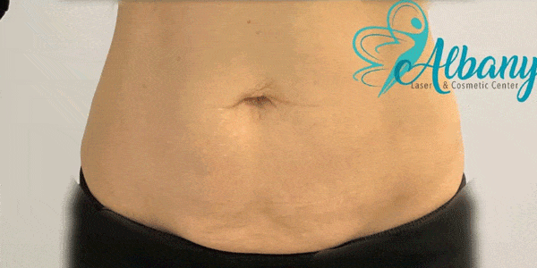 after non surgical tummy- tuck