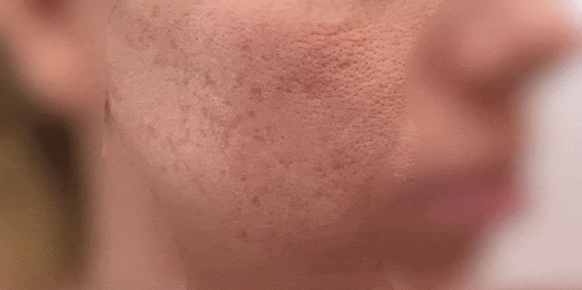 before-acne-scar-treatment-case-1118