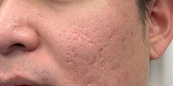 before-acne-scars-treatment-1019