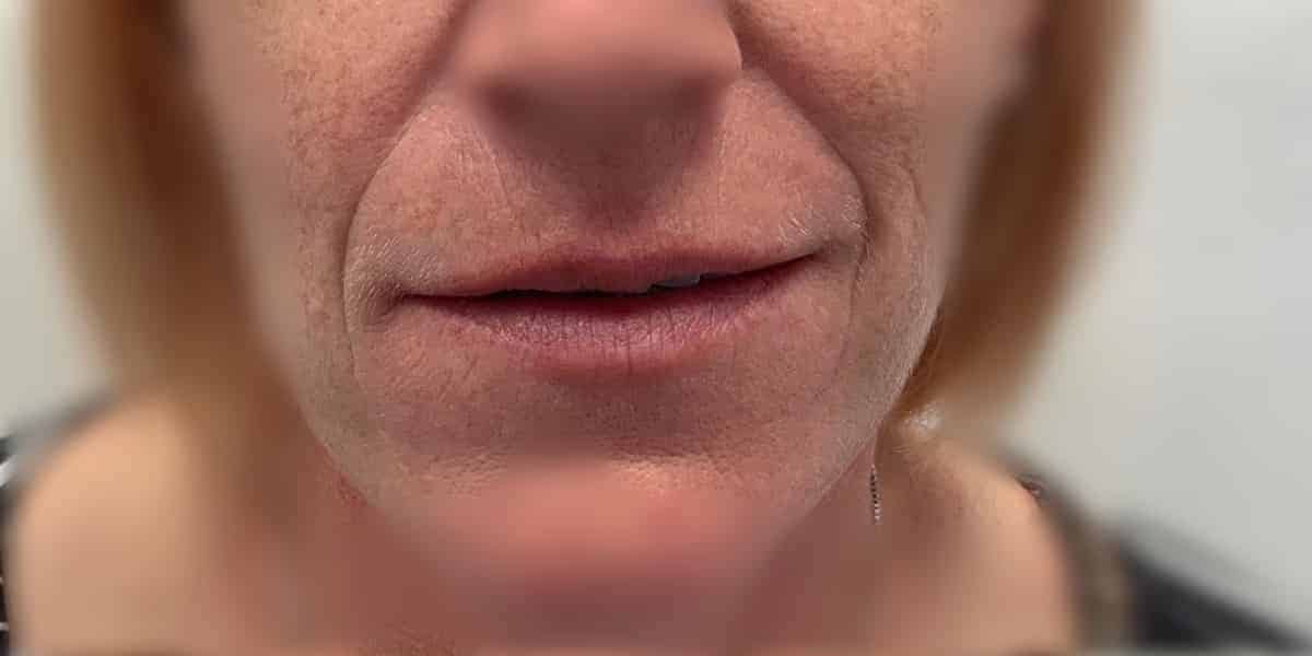 before nasolabial fold fillers