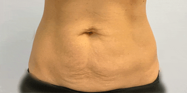 before non surgical tummy- tuck