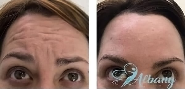 Botox results forehead line