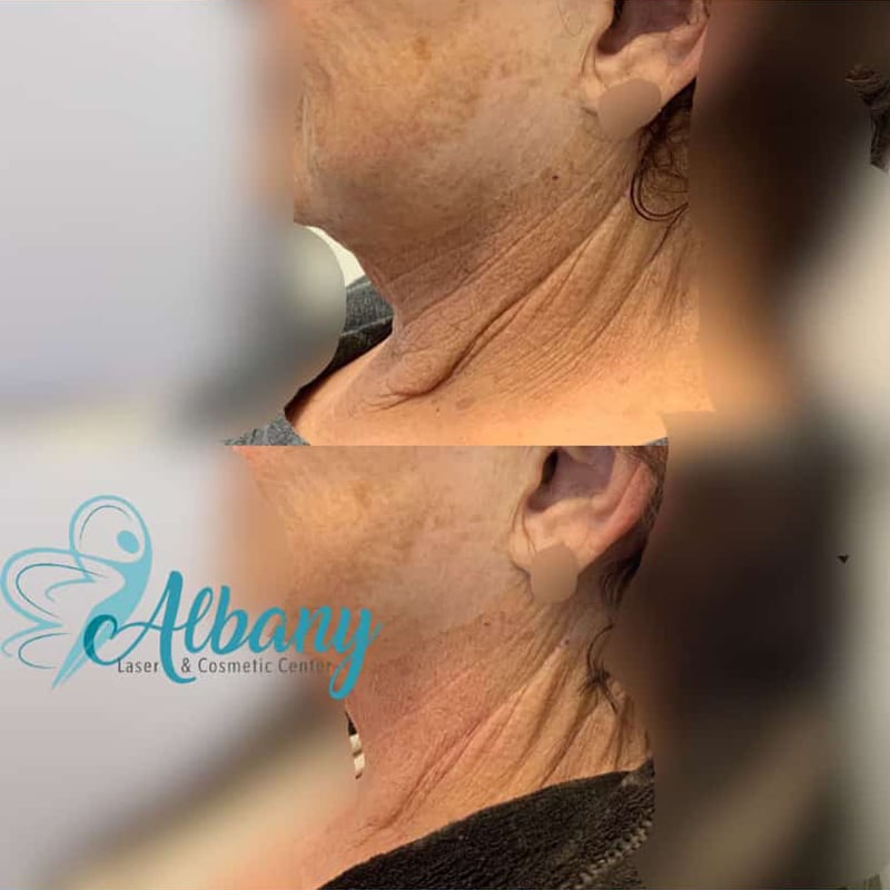 before and after neck tightening in Edmotnon