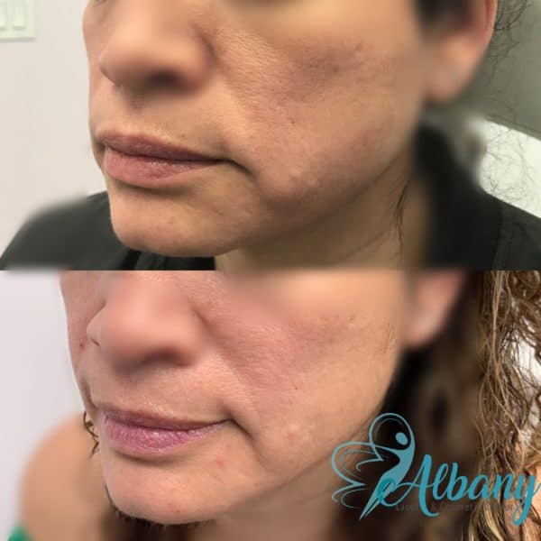 Facial rejuvenation