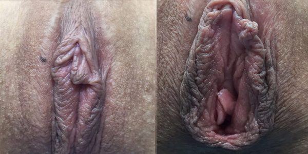 After vaginal whitening