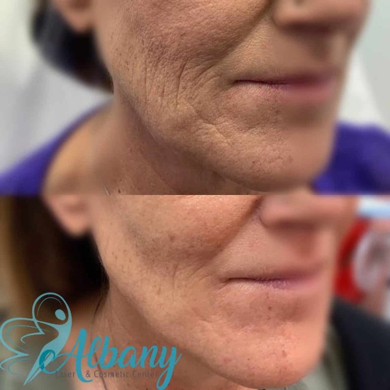 thread facelift before and after