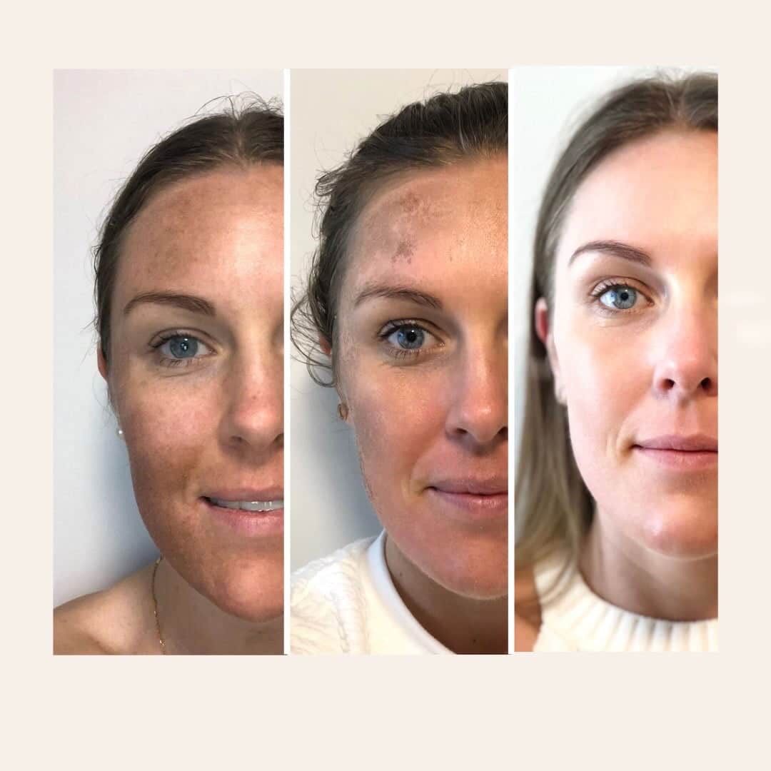 Three images of a woman's face showing skin improvement before, during, and after Fraxel Laser treatment at Albany Laser & Cosmetic Centre