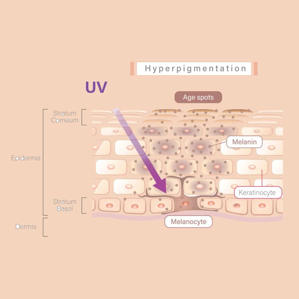 Hyperpigmentation Infographic