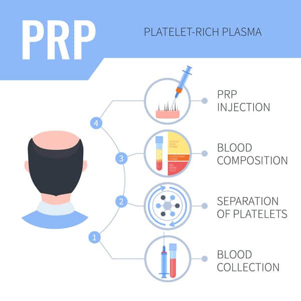 PRP procedure for hair loss