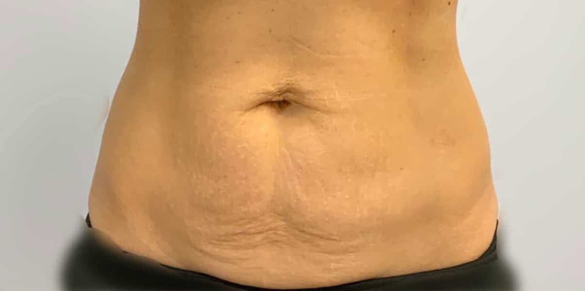 before sculpsure