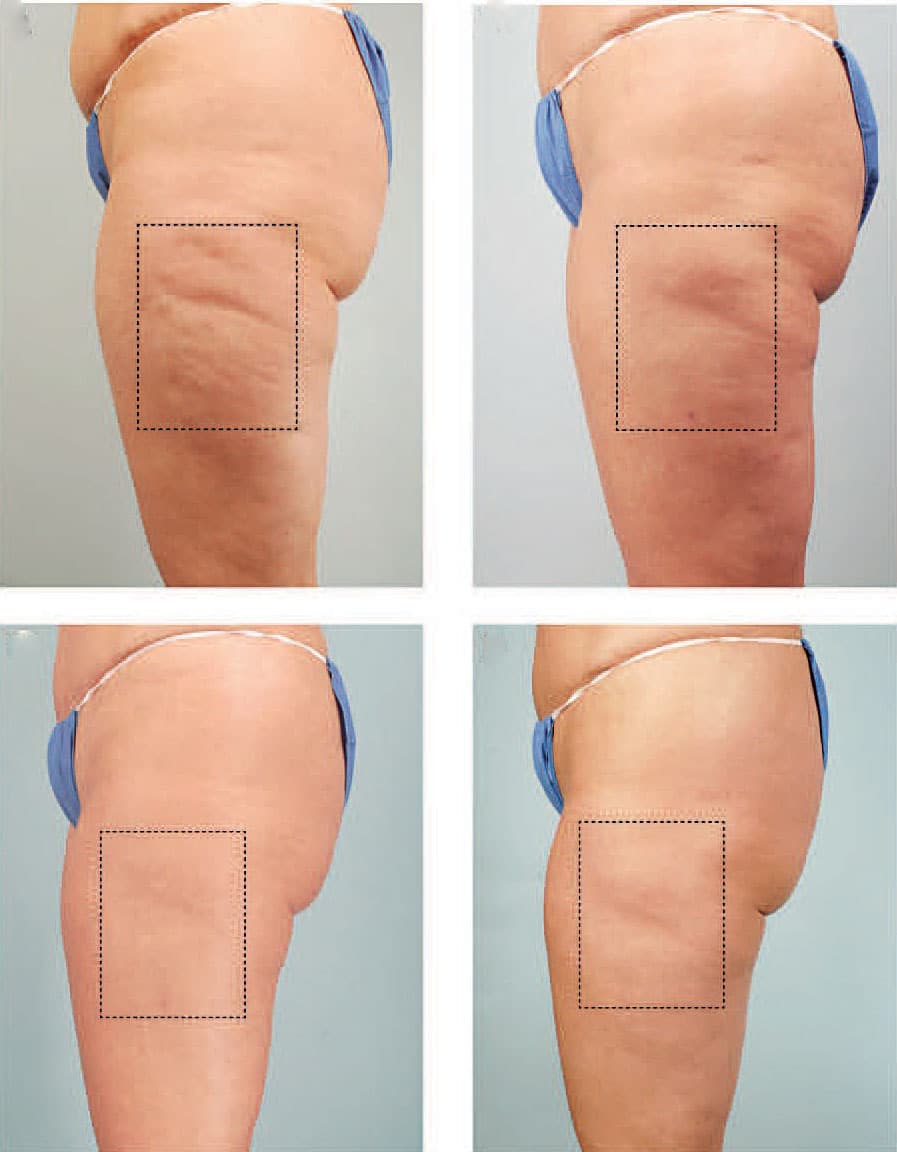 before and after cellulite treatment 2
