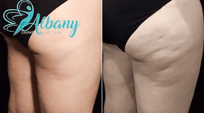 cellulite-treatment-results
